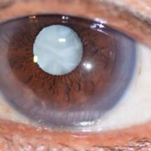 Chhattisgarh Marks Major Success in Eye Care: 11 Districts Declared Cataract Blindness Backlog-Free